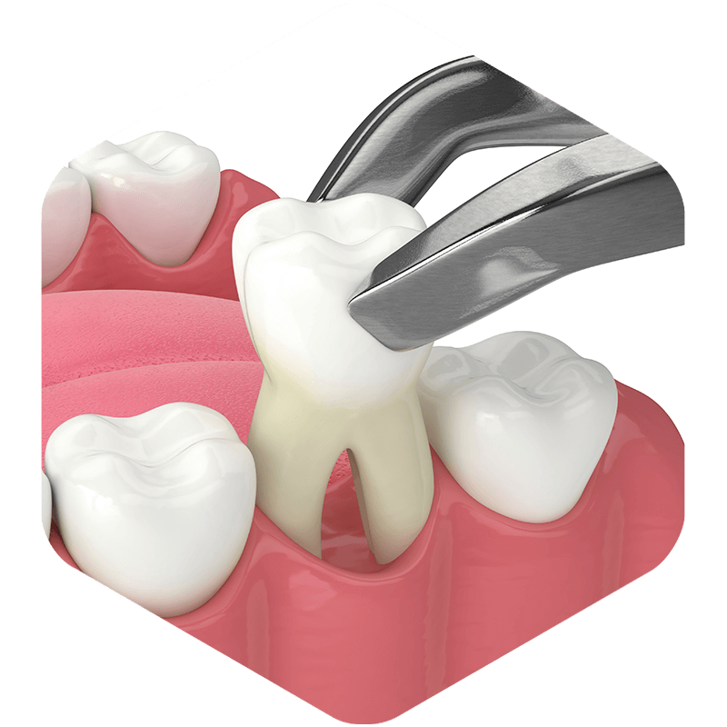3D illustration of a tooth being extracted.
